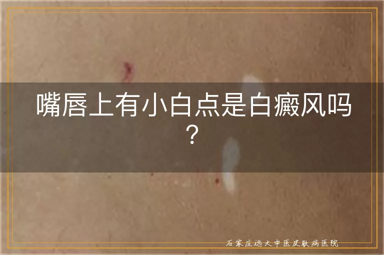 嘴唇上有小白点是白癜风吗？