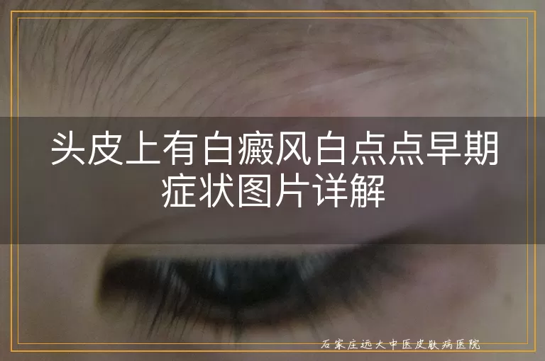 头皮上有白癜风白点点早期症状图片详解