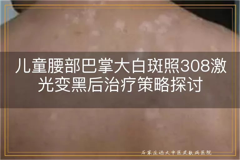 儿童腰部巴掌大白斑照308激光变黑后治疗策略探讨