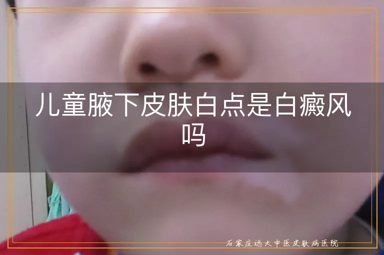儿童腋下皮肤白点是白癜风吗