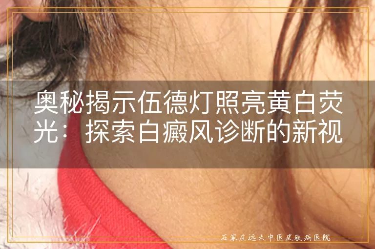 奥秘揭示伍德灯照亮黄白荧光：探索白癜风诊断的新视野