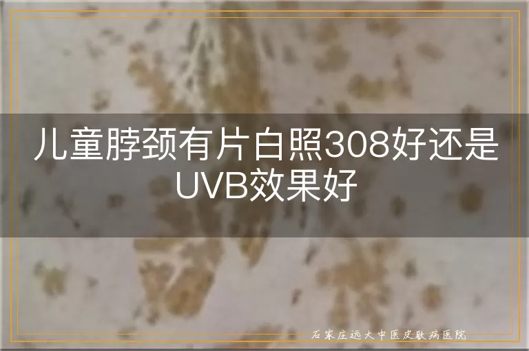 儿童脖颈有片白照308好还是UVB效果好