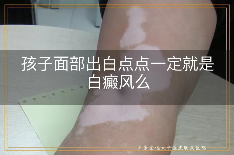 孩子面部出白点点一定就是白癜风么