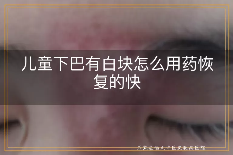 儿童下巴有白块怎么用药恢复的快