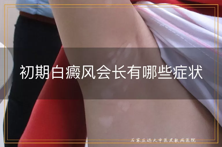 初期白癜风会长有哪些症状