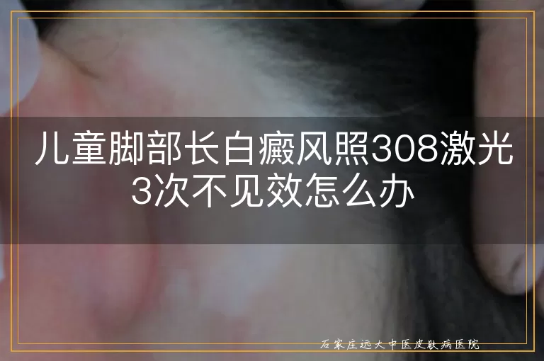 儿童脚部长白癜风照308激光3次不见效怎么办