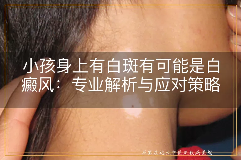 小孩身上有白斑有可能是白癜风：专业解析与应对策略