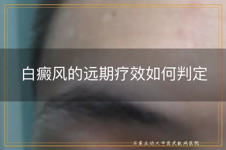 白癜风的远期疗效如何判定