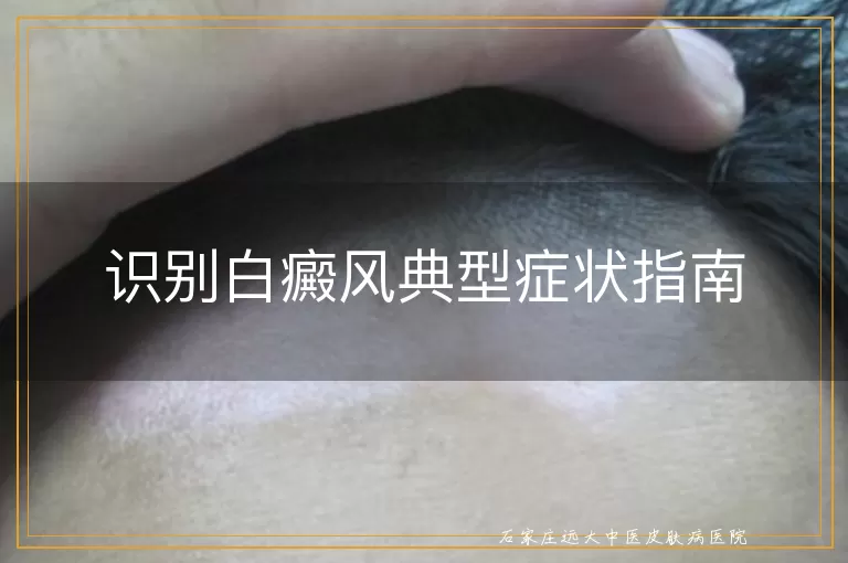 识别白癜风典型症状指南