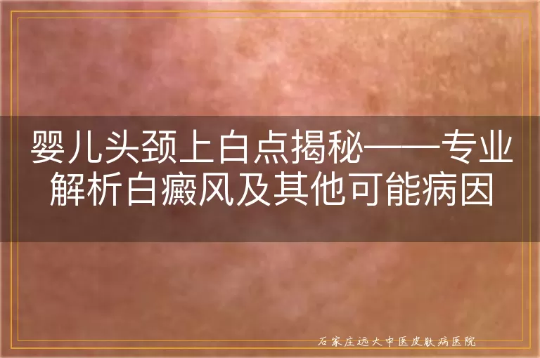 婴儿头颈上白点揭秘——专业解析白癜风及其他可能病因