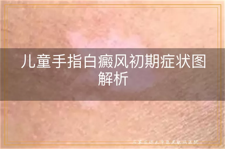 儿童手指白癜风初期症状图解析