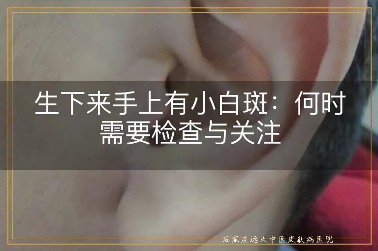生下来手上有小白斑:何时需要检查与关注
