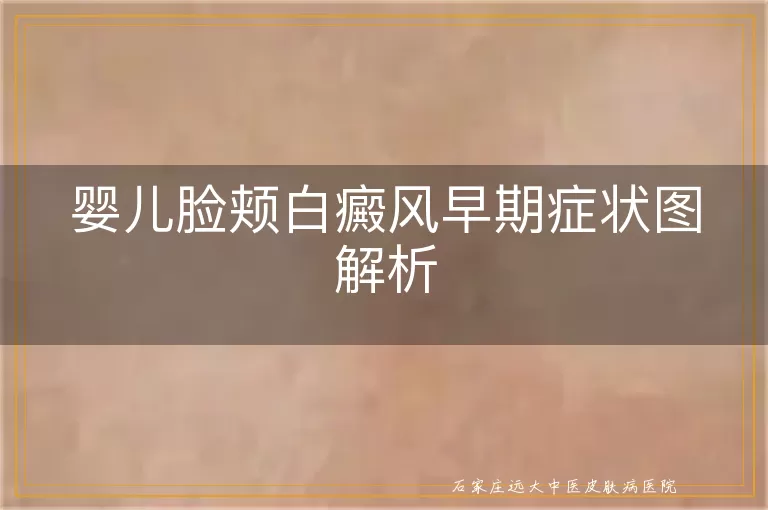 婴儿脸颊白癜风早期症状图解析