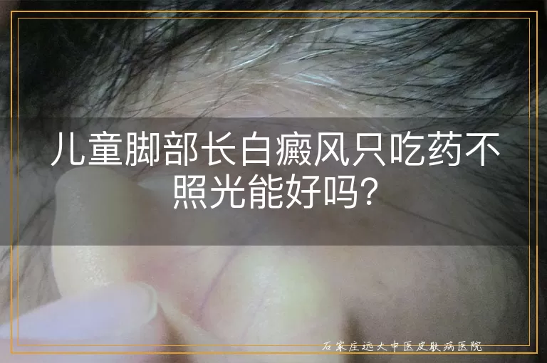儿童脚部长白癜风只吃药不照光能好吗？