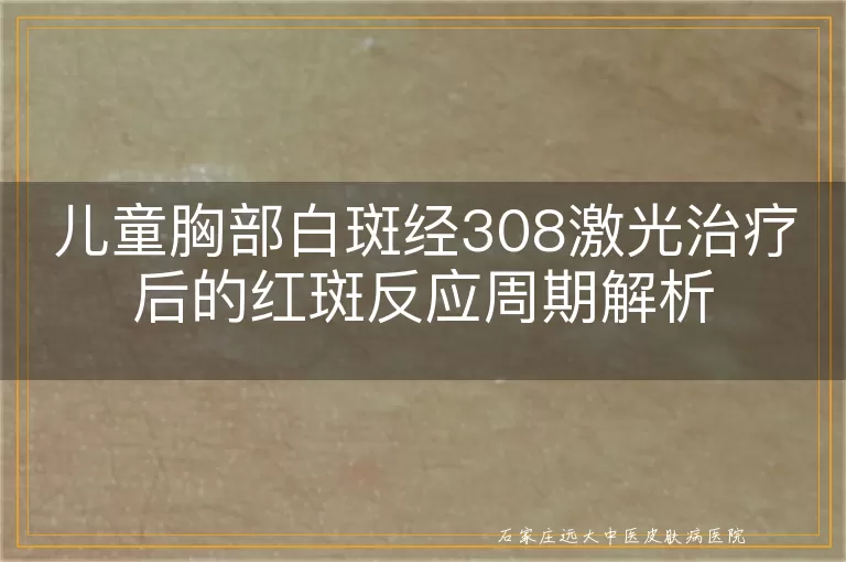 儿童胸部白斑经308激光治疗后的红斑反应周期解析