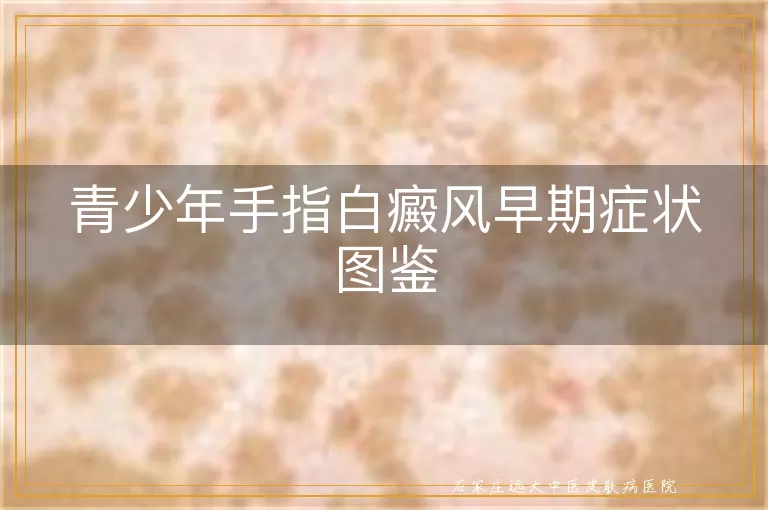 青少年手指白癜风早期症状图鉴