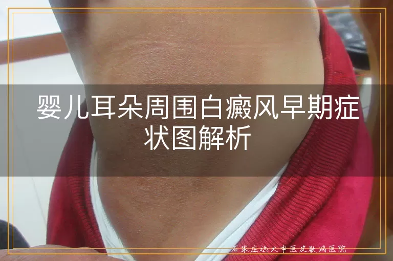 婴儿耳朵周围白癜风早期症状图解析