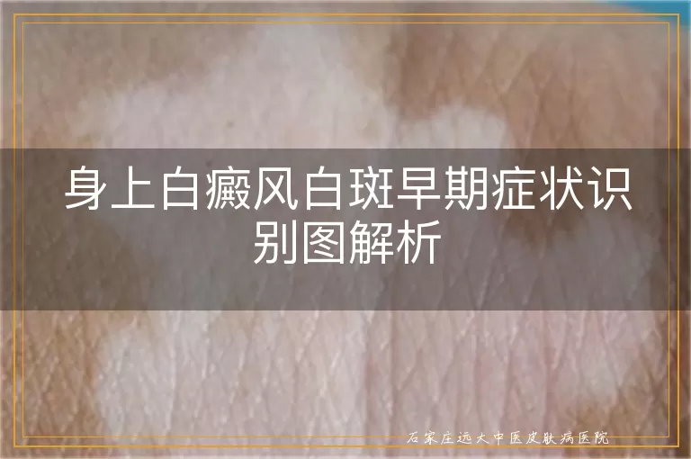 身上白癜风白斑早期症状识别图解析