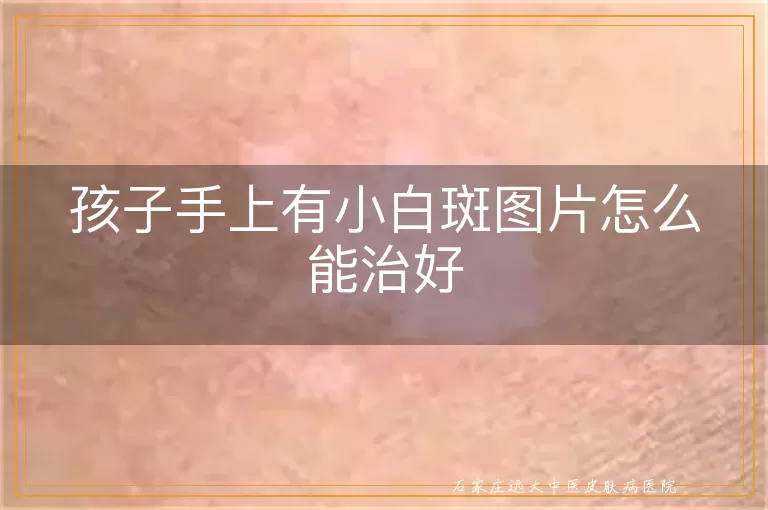 孩子手上有小白斑图片怎么能治好