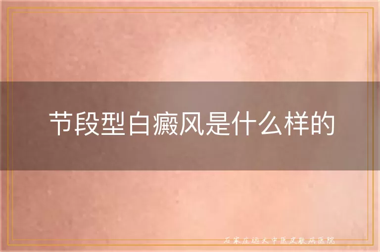 节段型白癜风是什么样的