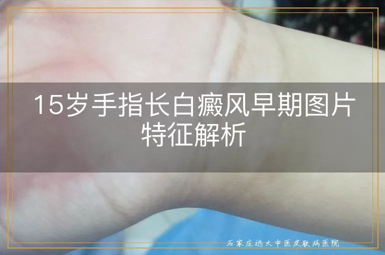 15岁手指长白癜风早期图片特征解析
