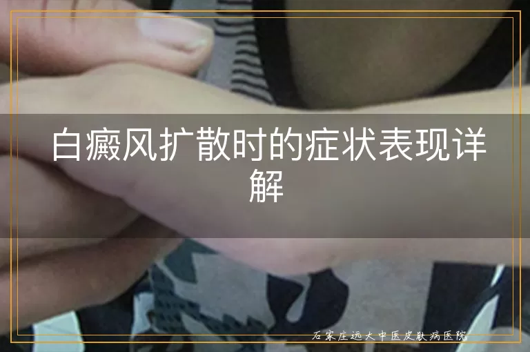 白癜风扩散时的症状表现详解