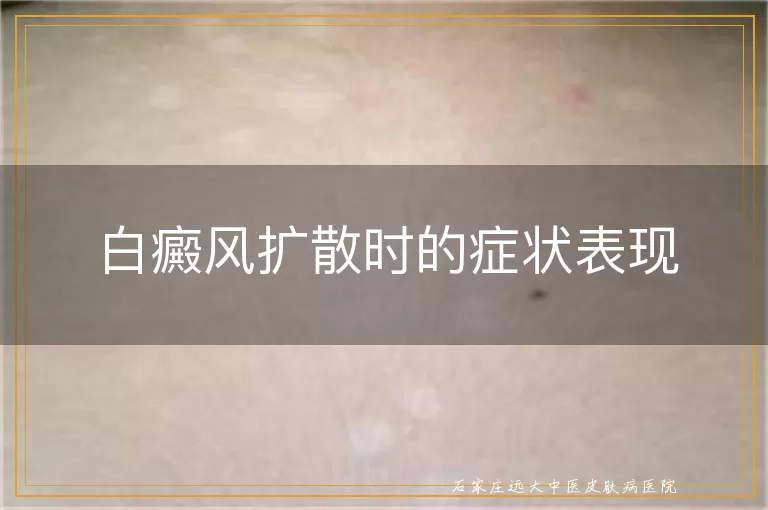 白癜风扩散时的症状表现