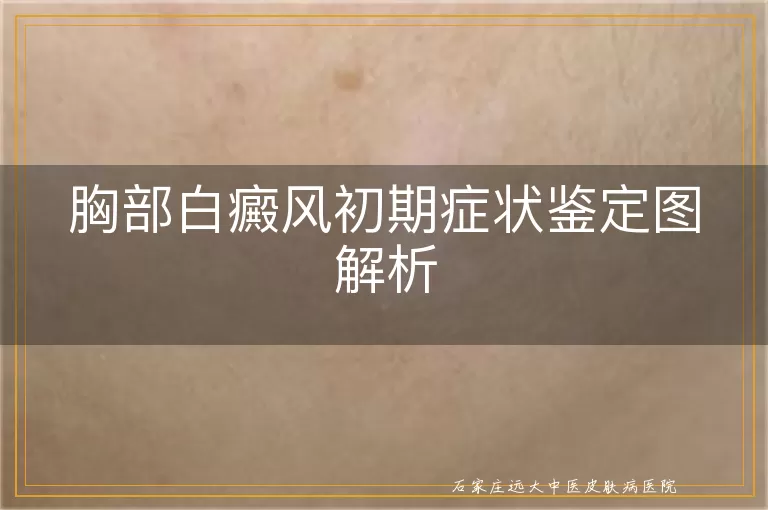 胸部白癜风初期症状鉴定图解析