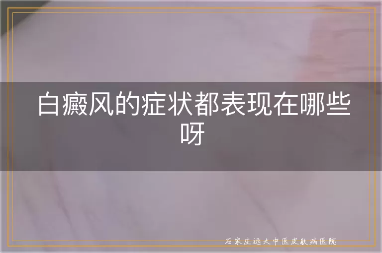 白癜风的症状都表现在哪些呀