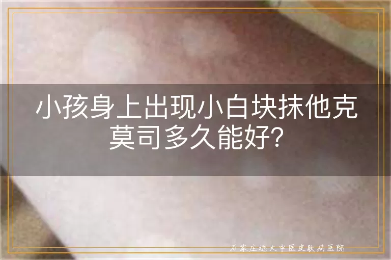 小孩身上出现小白块抹他克莫司多久能好？