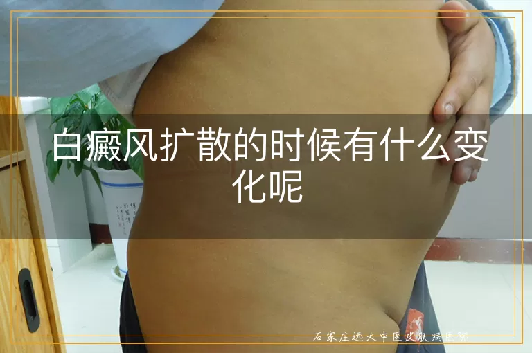白癜风扩散的时候有什么变化呢