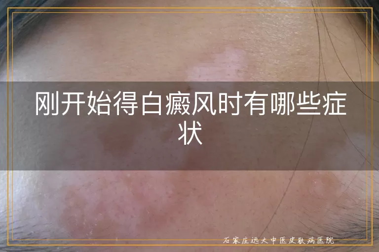 刚开始得白癜风时有哪些症状