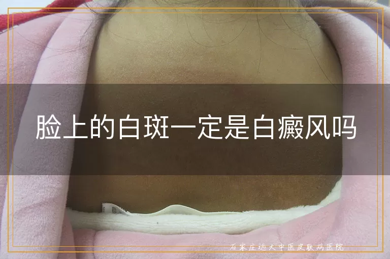 脸上的白斑一定是白癜风吗