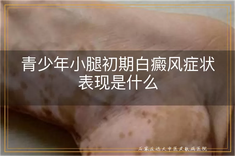 青少年小腿初期白癜风症状表现是什么