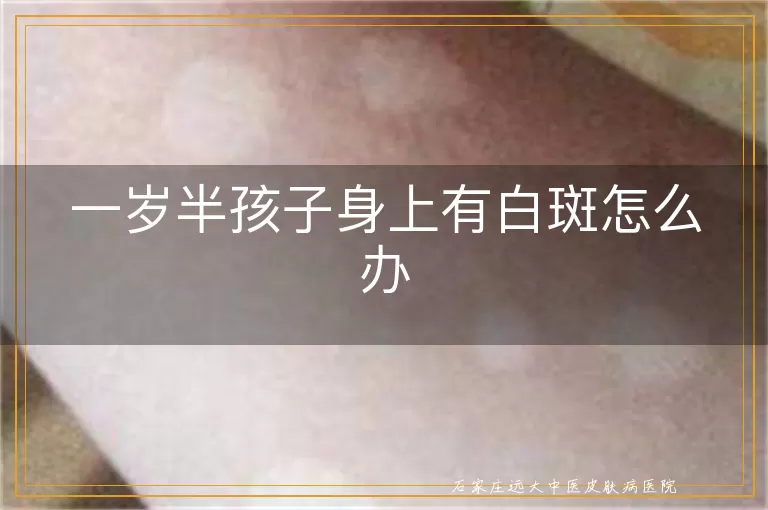 一岁半孩子身上有白斑怎么办