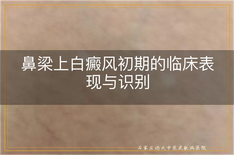 鼻梁上白癜风初期的临床表现与识别