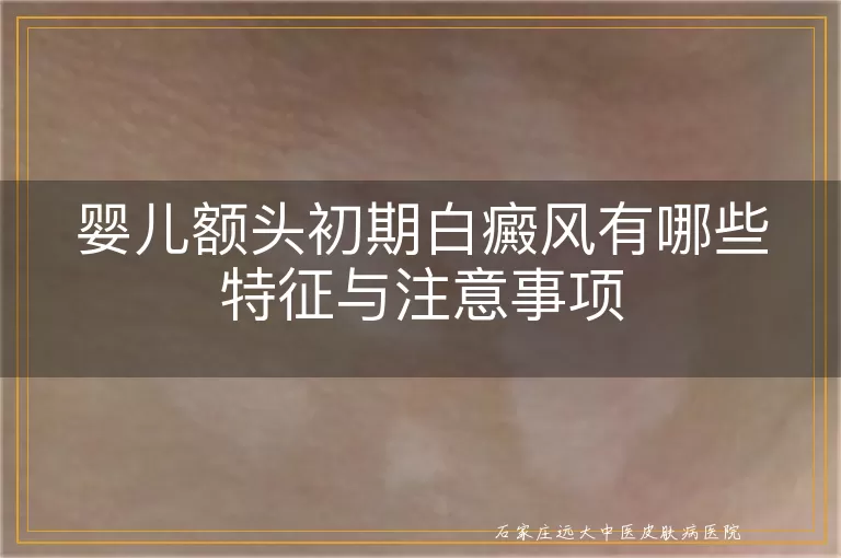 婴儿额头初期白癜风有哪些特征与注意事项