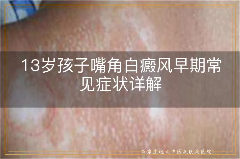 13岁孩子嘴角白癜风早期常见症状详解