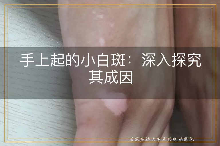 手上起的小白斑：深入探究其成因