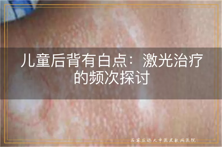 儿童后背有白点：激光治疗的频次探讨
