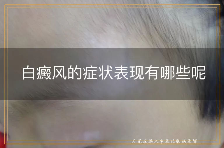 白癜风的症状表现有哪些呢