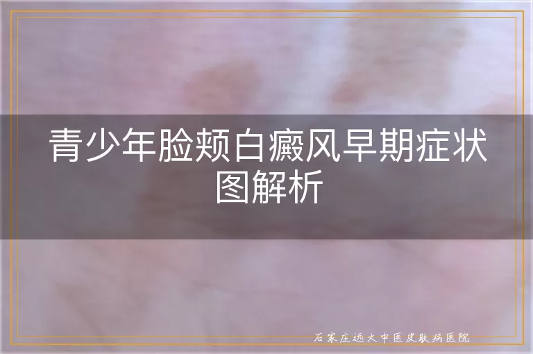 青少年脸颊白癜风早期症状图解析