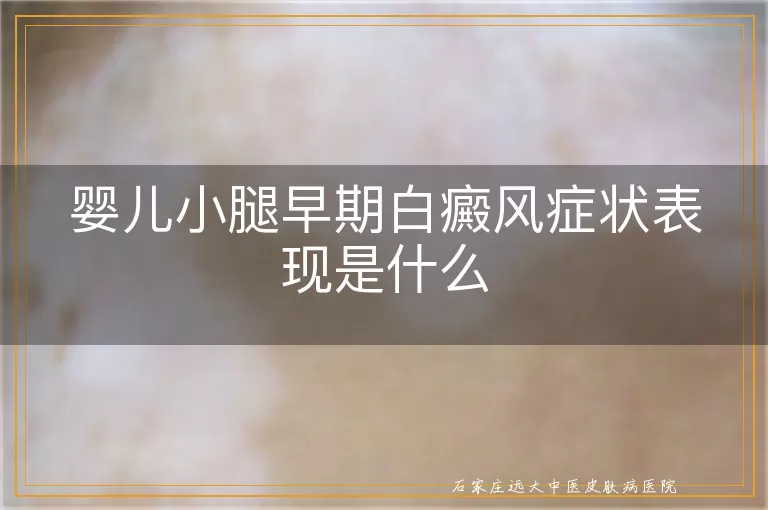 婴儿小腿早期白癜风症状表现是什么