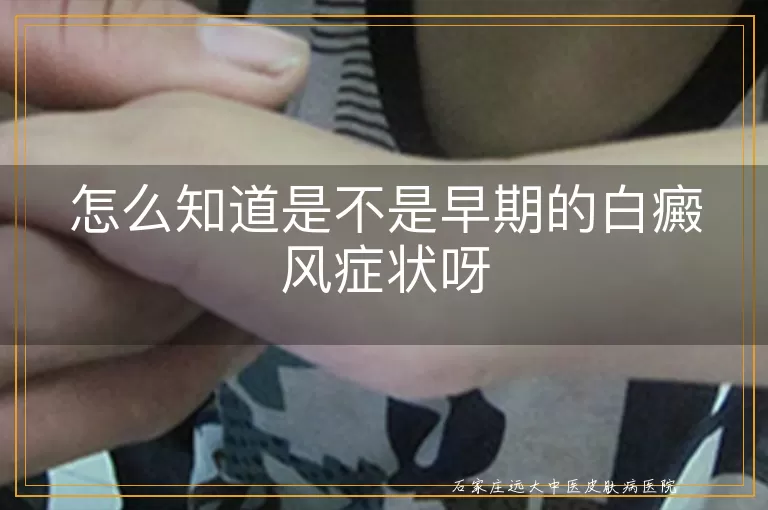 怎么知道是不是早期的白癜风症状呀