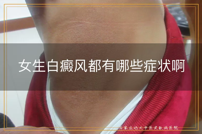 女生白癜风都有哪些症状啊