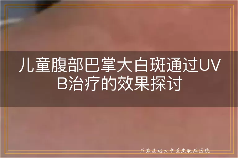 儿童腹部巴掌大白斑通过UVB治疗的效果探讨