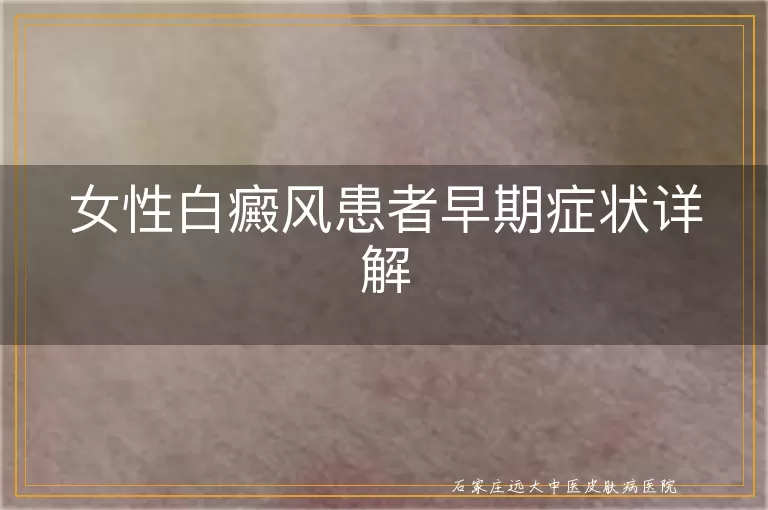 女性白癜风患者早期症状详解