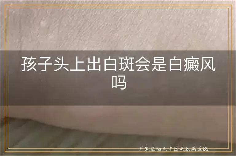 孩子头上出白斑会是白癜风吗