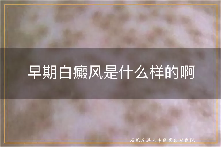 早期白癜风是什么样的啊