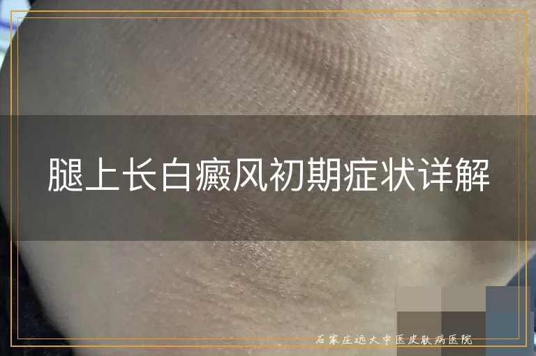 腿上长白癜风初期症状详解